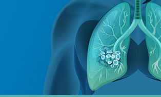 fast-facts-lungs-genetic-testing-314x190